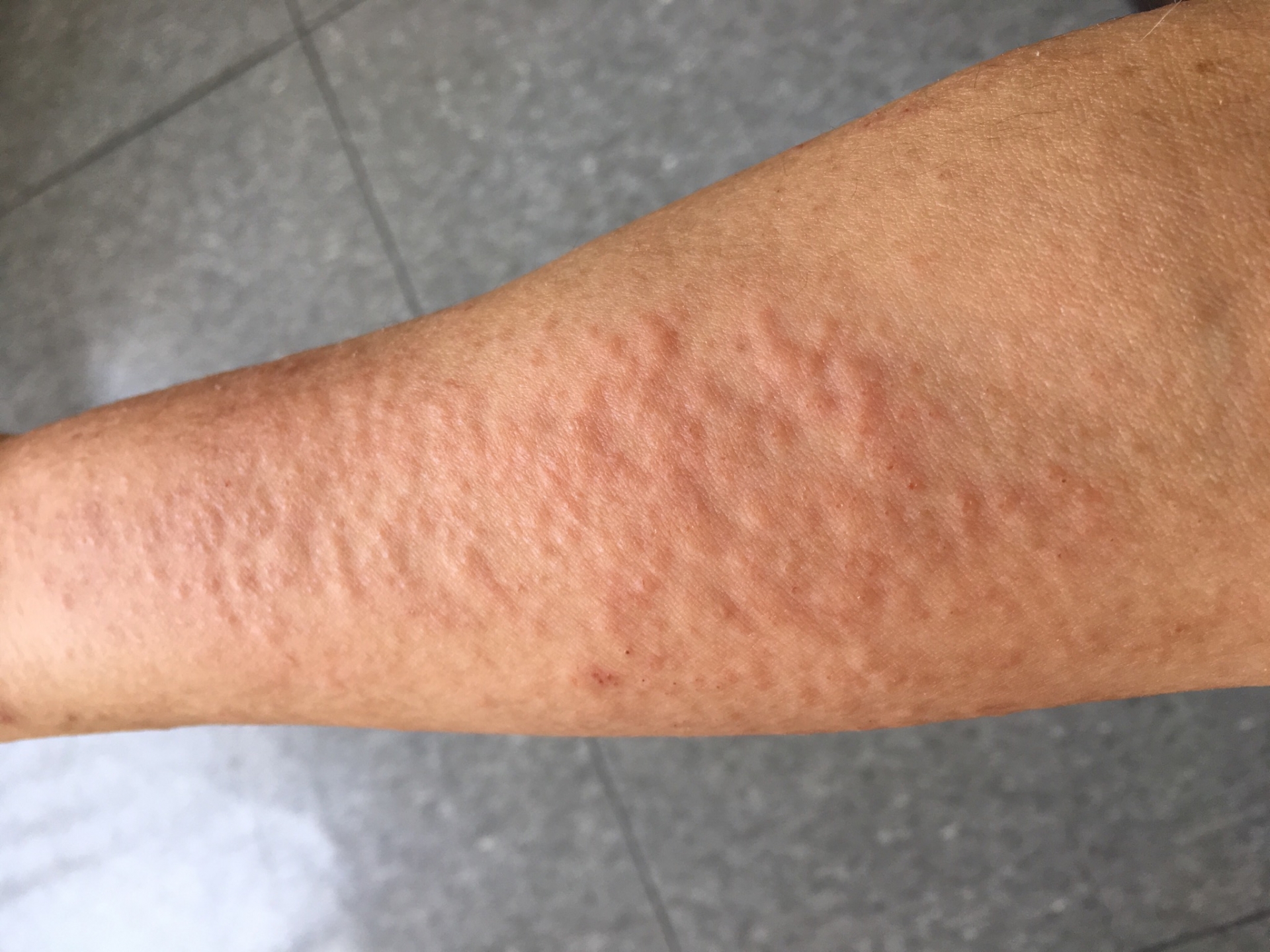 アトピー 蕁麻疹 汗 アレルギー